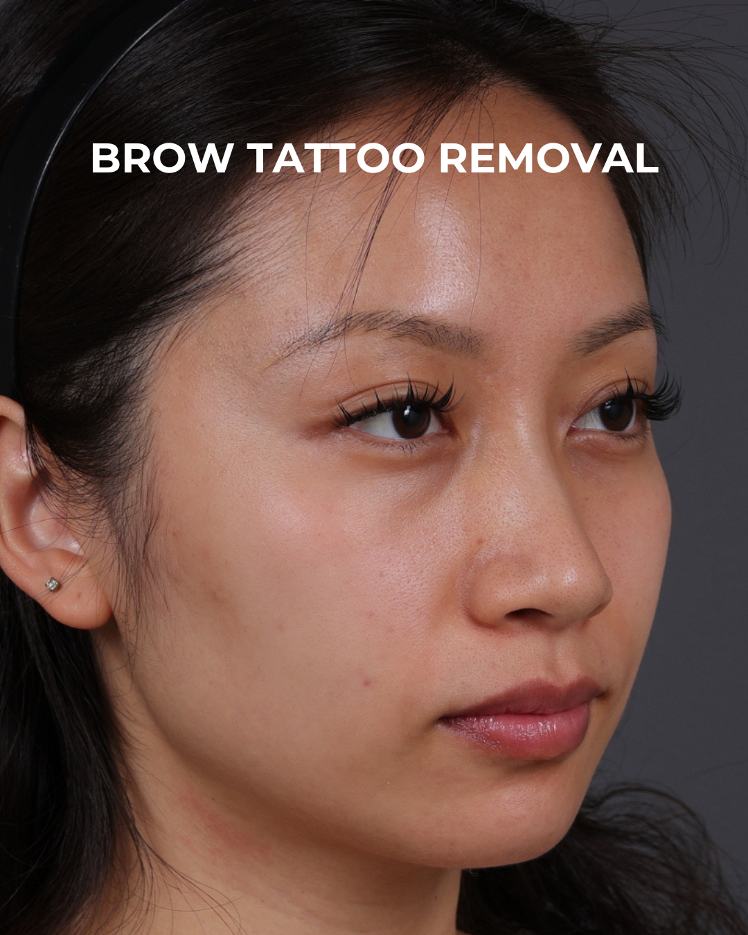 Brow Tattoo Removal Before & After Gallery - Patient 179499 - Image 4