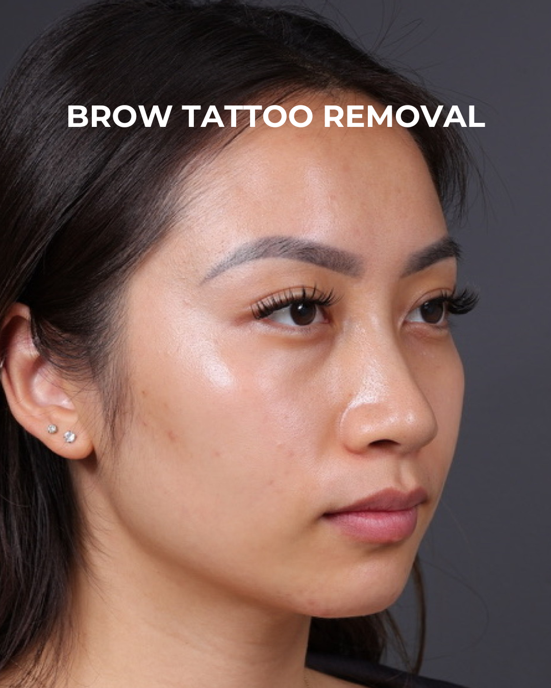 Brow Tattoo Removal Before & After Gallery - Patient 179499 - Image 3