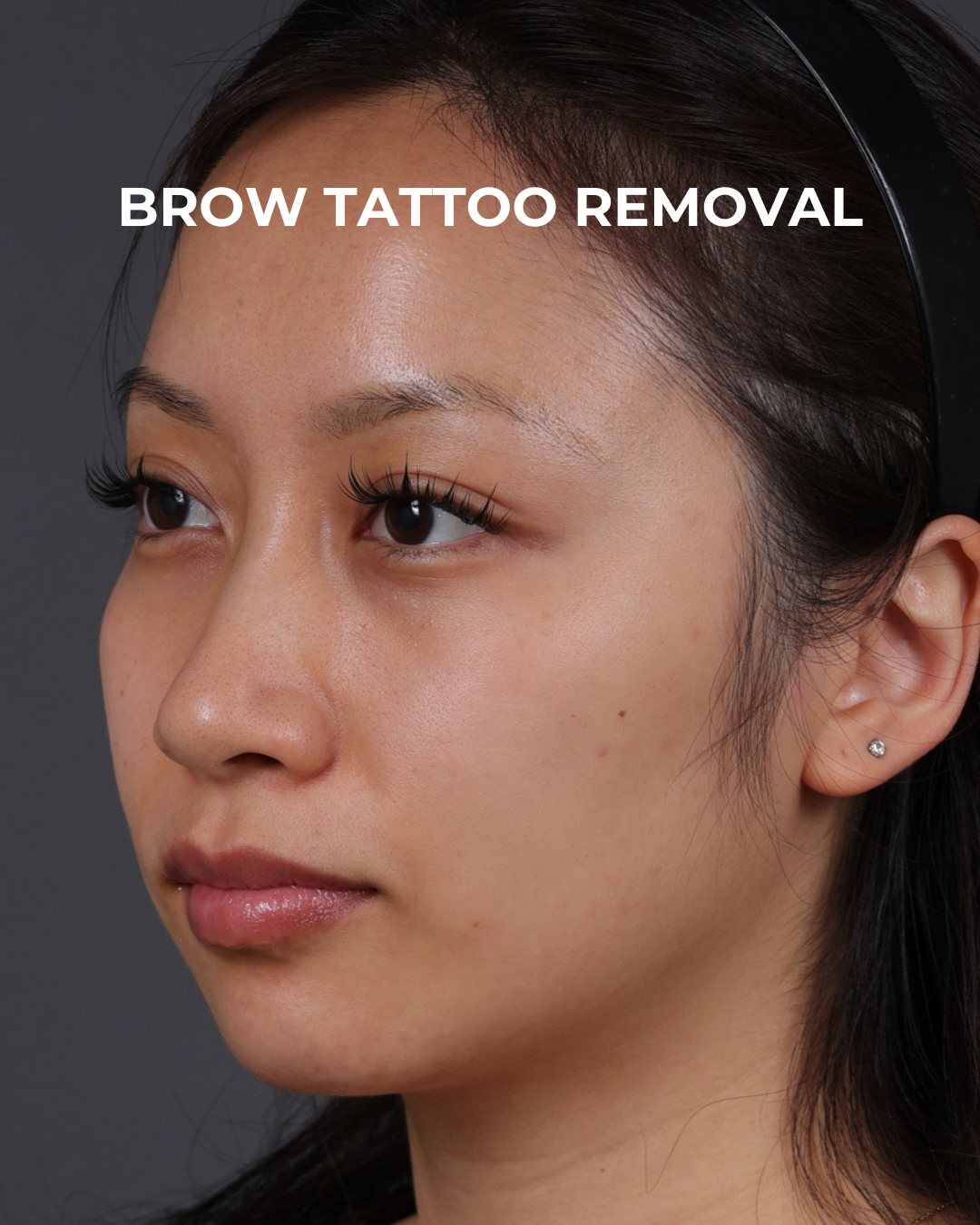 Brow Tattoo Removal Before & After Gallery - Patient 179499 - Image 6