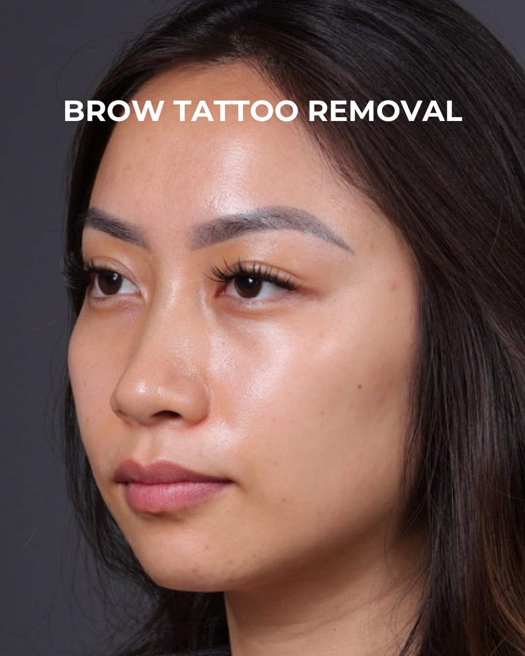 Brow Tattoo Removal Before & After Gallery - Patient 179499 - Image 5