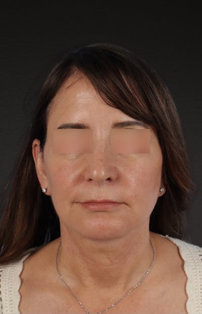Neck Lift Before & After Gallery - Patient 428433 - Image 2