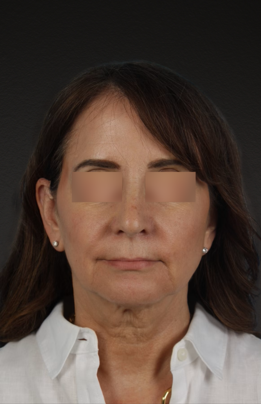 Neck Lift Before & After Gallery - Patient 428433 - Image 1