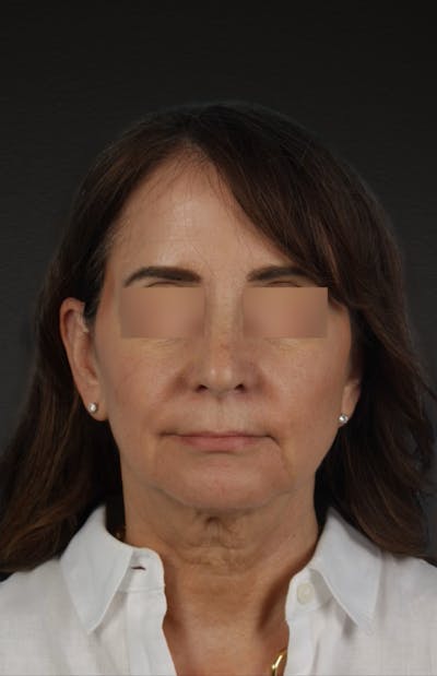 Neck Lift Before & After Gallery - Patient 428433 - Image 1