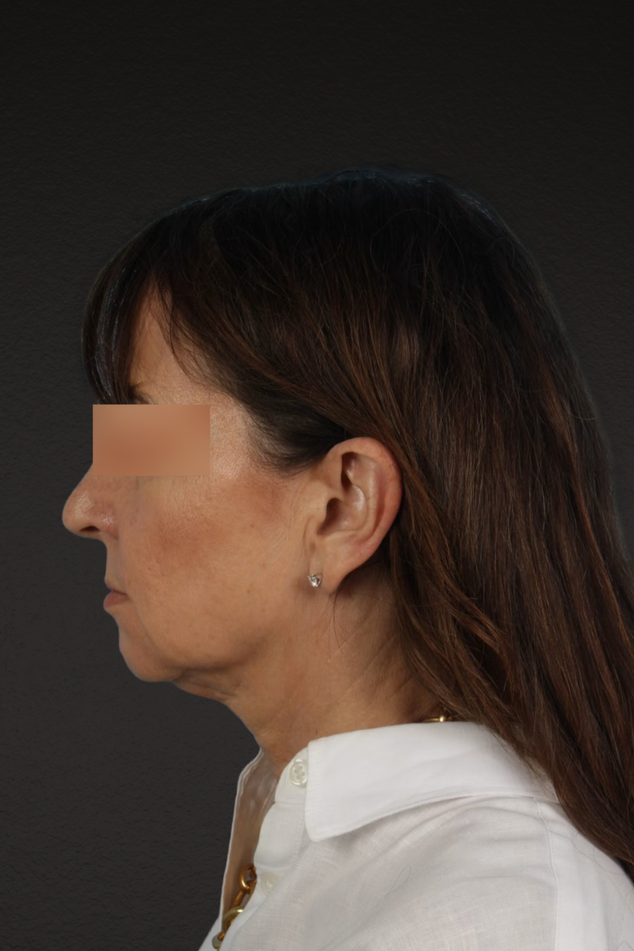 Neck Lift Before & After Gallery - Patient 428433 - Image 9