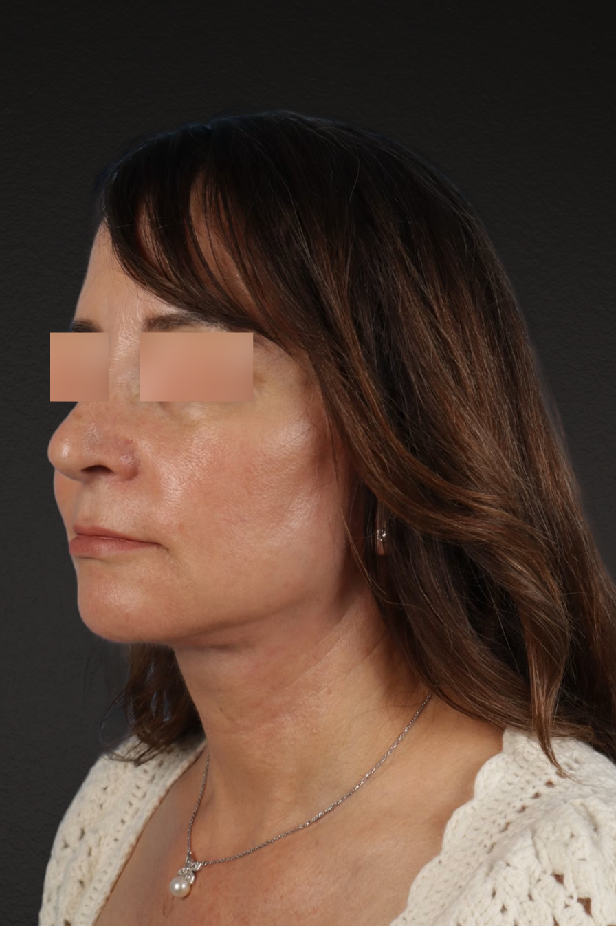 Neck Lift Before & After Gallery - Patient 428433 - Image 8