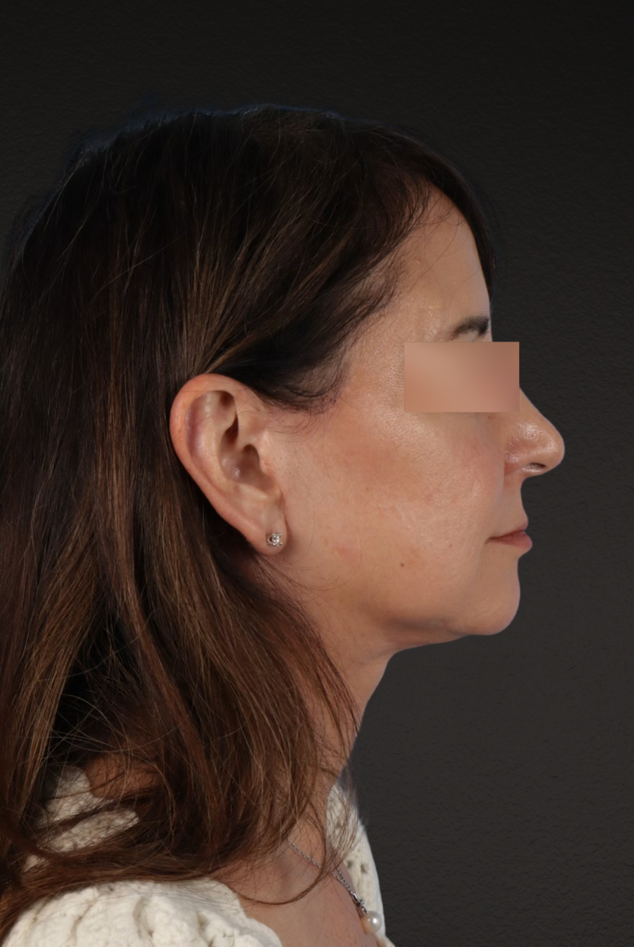 Neck Lift Before & After Gallery - Patient 428433 - Image 6