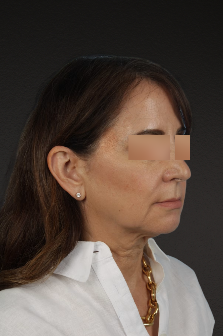 Neck Lift Before & After Gallery - Patient 428433 - Image 3