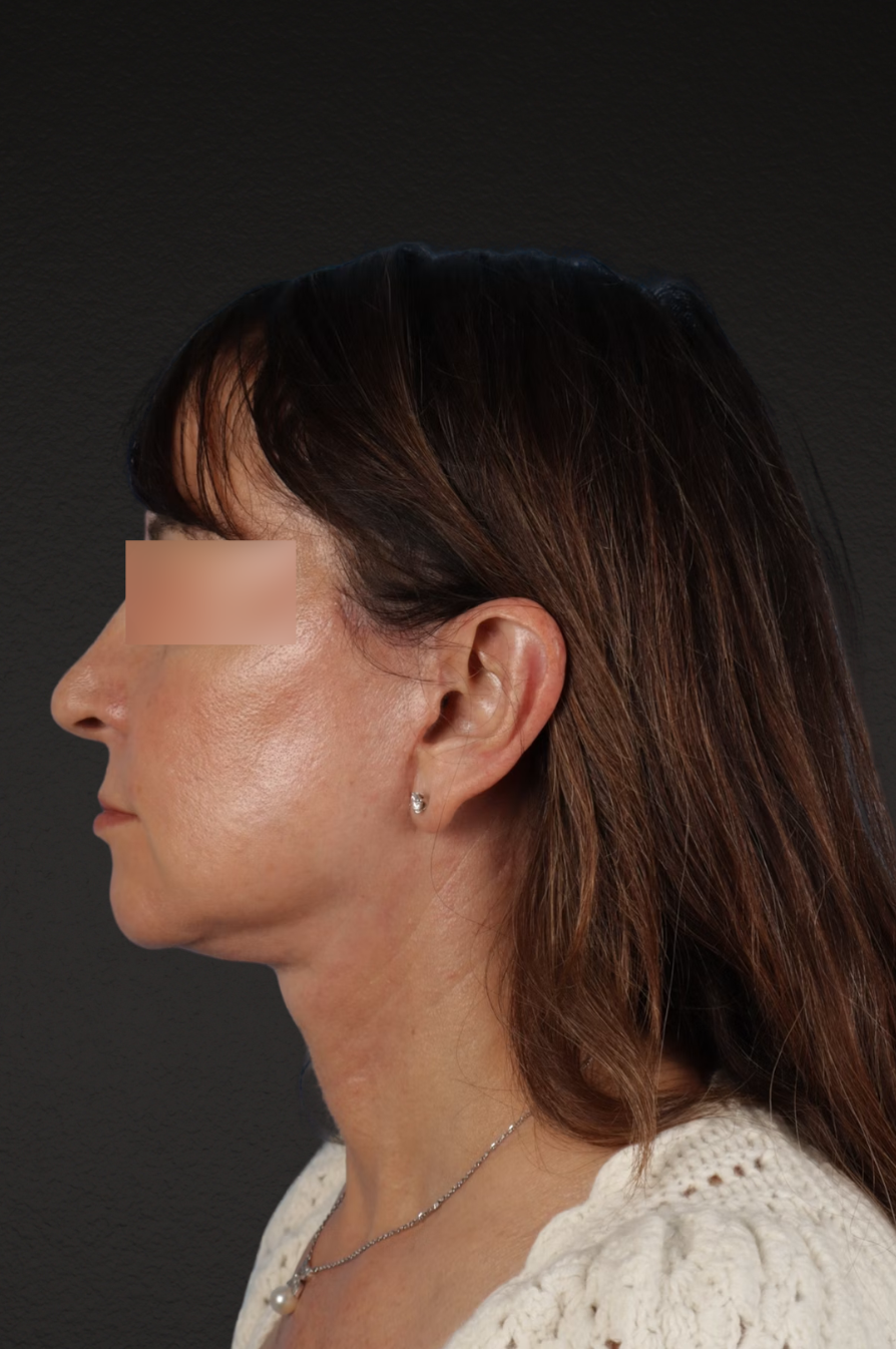 Neck Lift Before & After Gallery - Patient 428433 - Image 10