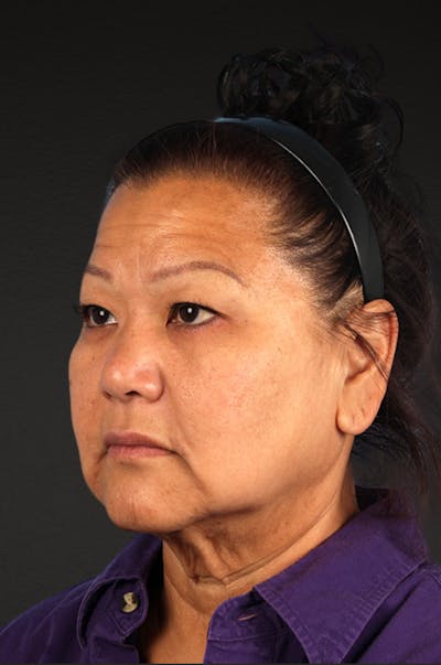 Neck Lift Before & After Gallery - Patient 196183 - Image 1