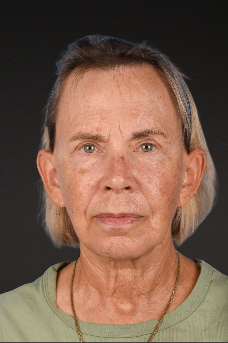 Neck Lift Before & After Gallery - Patient 310482 - Image 2