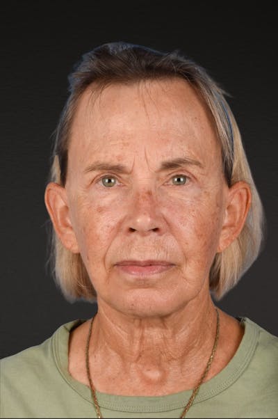 Neck Lift Before & After Gallery - Patient 310482 - Image 2