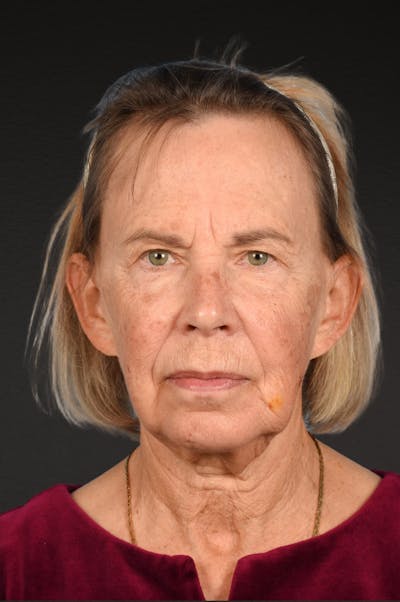 Neck Lift Before & After Gallery - Patient 310482 - Image 1