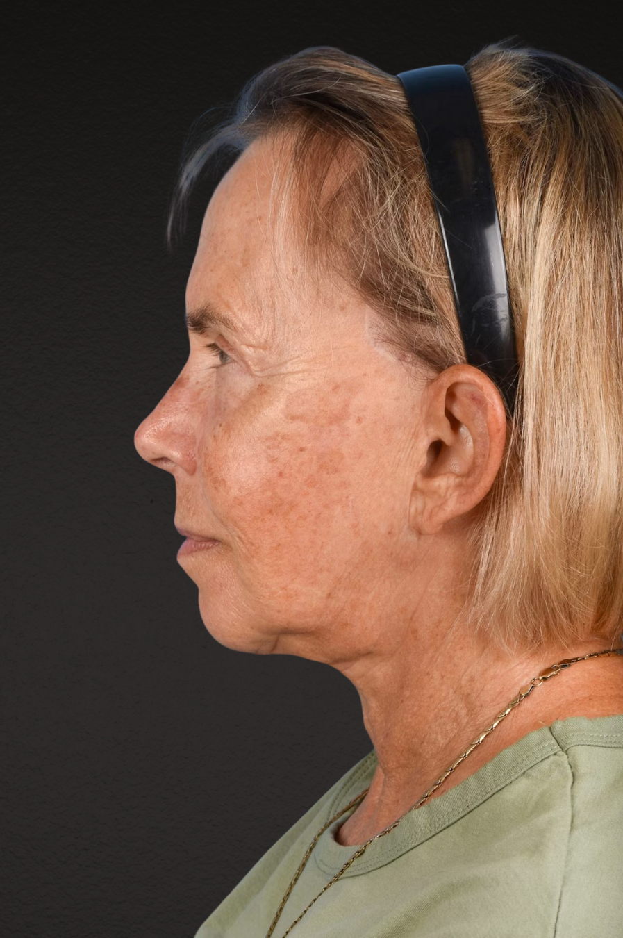 Neck Lift Before & After Gallery - Patient 310482 - Image 6