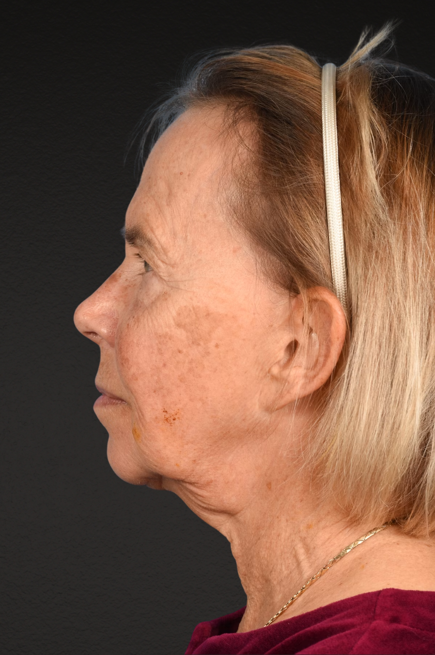 Neck Lift Before & After Gallery - Patient 310482 - Image 5