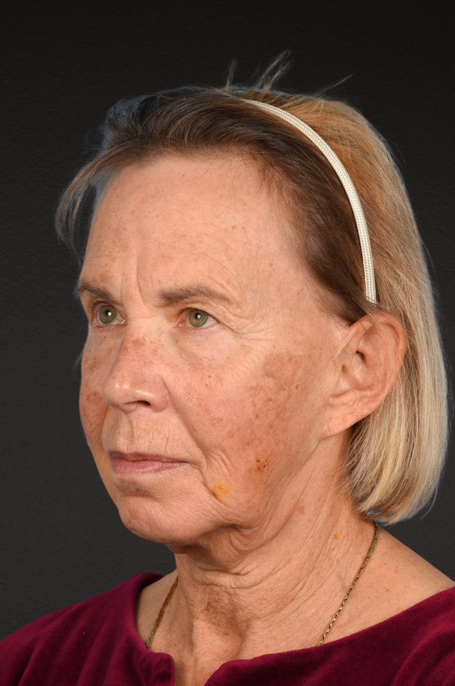 Neck Lift Before & After Gallery - Patient 310482 - Image 3