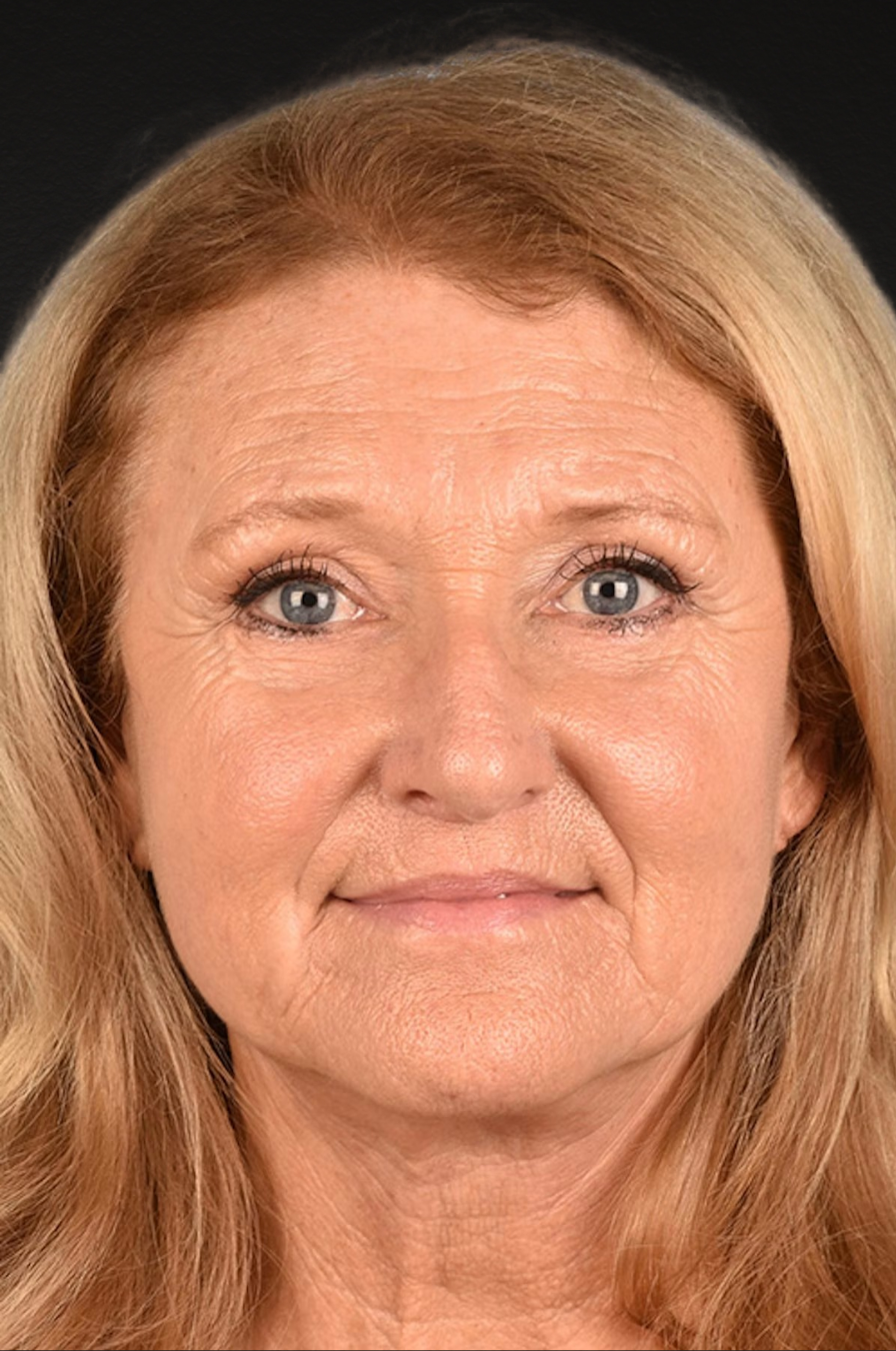 Neck Lift Before & After Gallery - Patient 302253 - Image 2