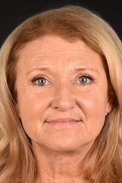 Neck Lift Before & After Gallery - Patient 302253 - Image 2