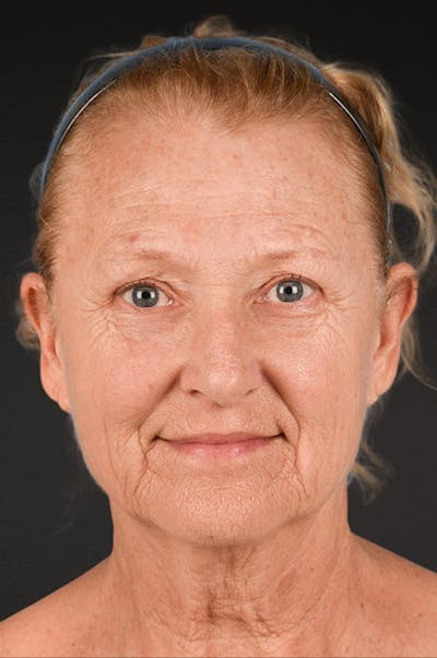 Neck Lift Before & After Gallery - Patient 302253 - Image 1