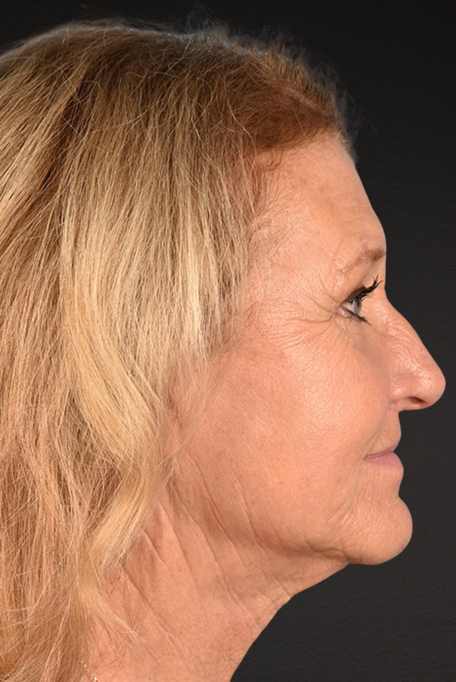 Neck Lift Before & After Gallery - Patient 302253 - Image 6
