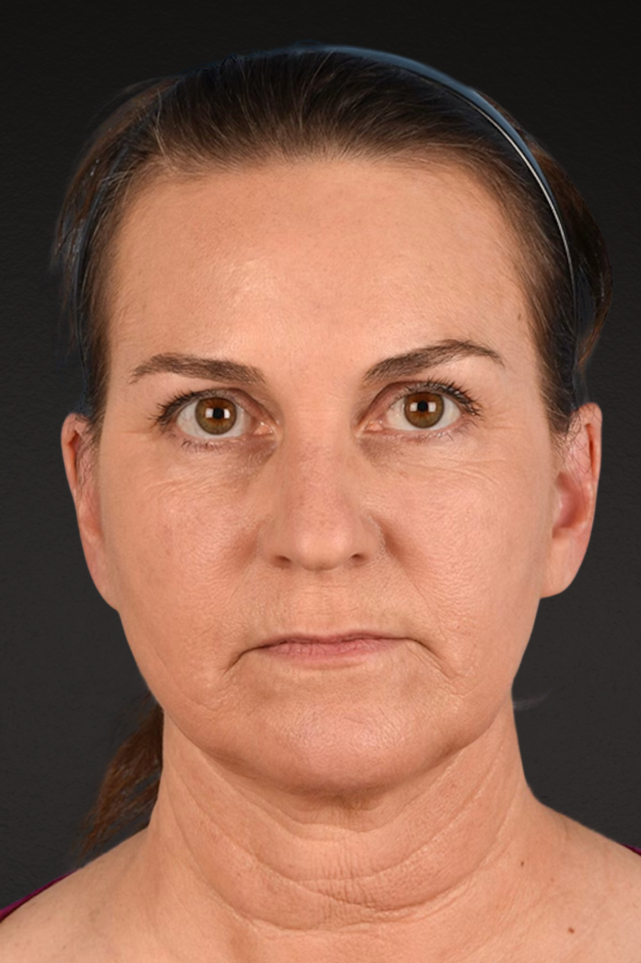 Neck Lift Before & After Gallery - Patient 169561 - Image 2