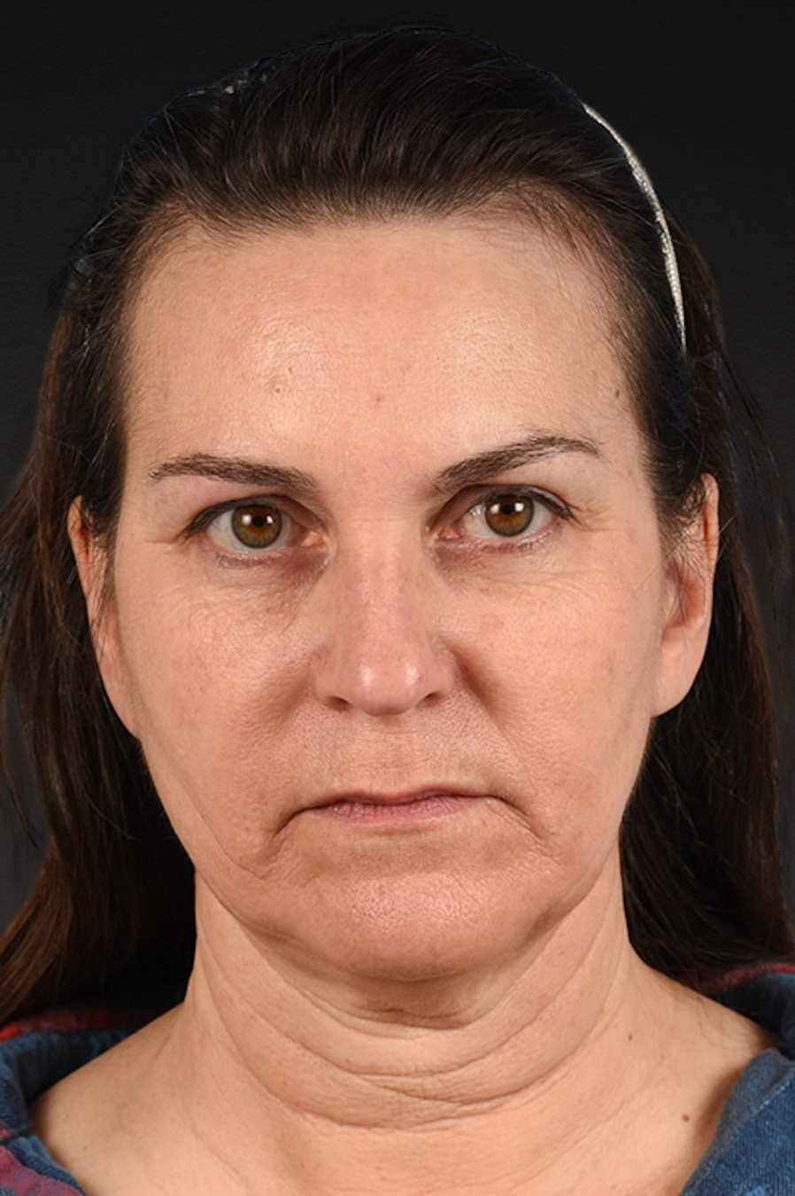Neck Lift Before & After Gallery - Patient 169561 - Image 1