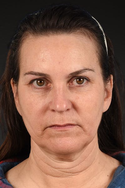 Neck Lift Before & After Gallery - Patient 169561 - Image 1