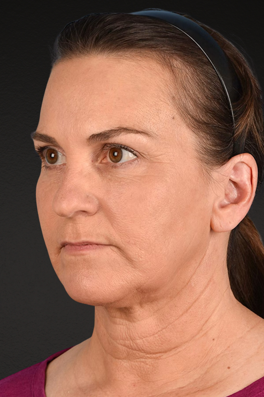 Neck Lift Before & After Gallery - Patient 169561 - Image 8