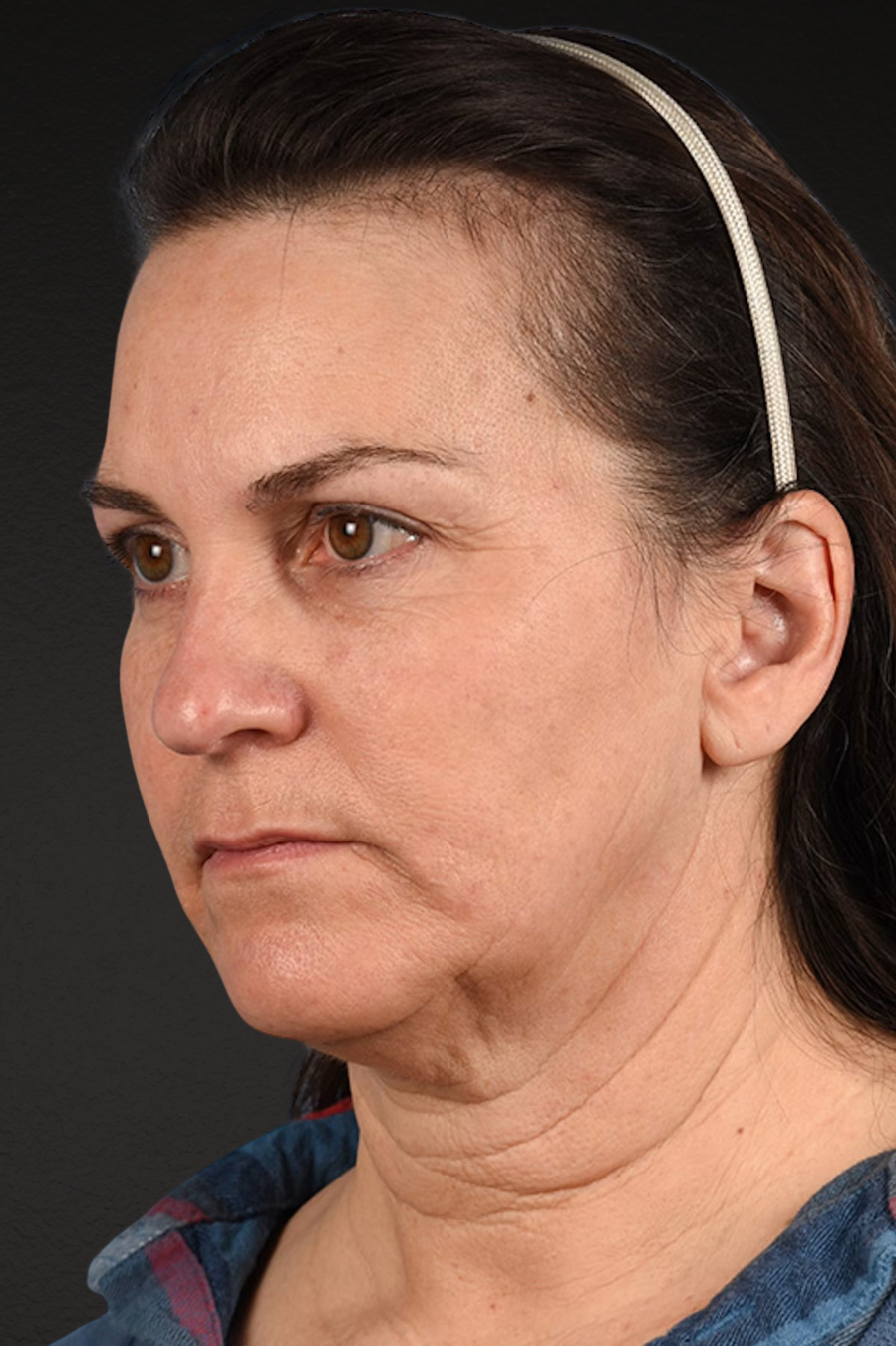 Neck Lift Before & After Gallery - Patient 169561 - Image 7