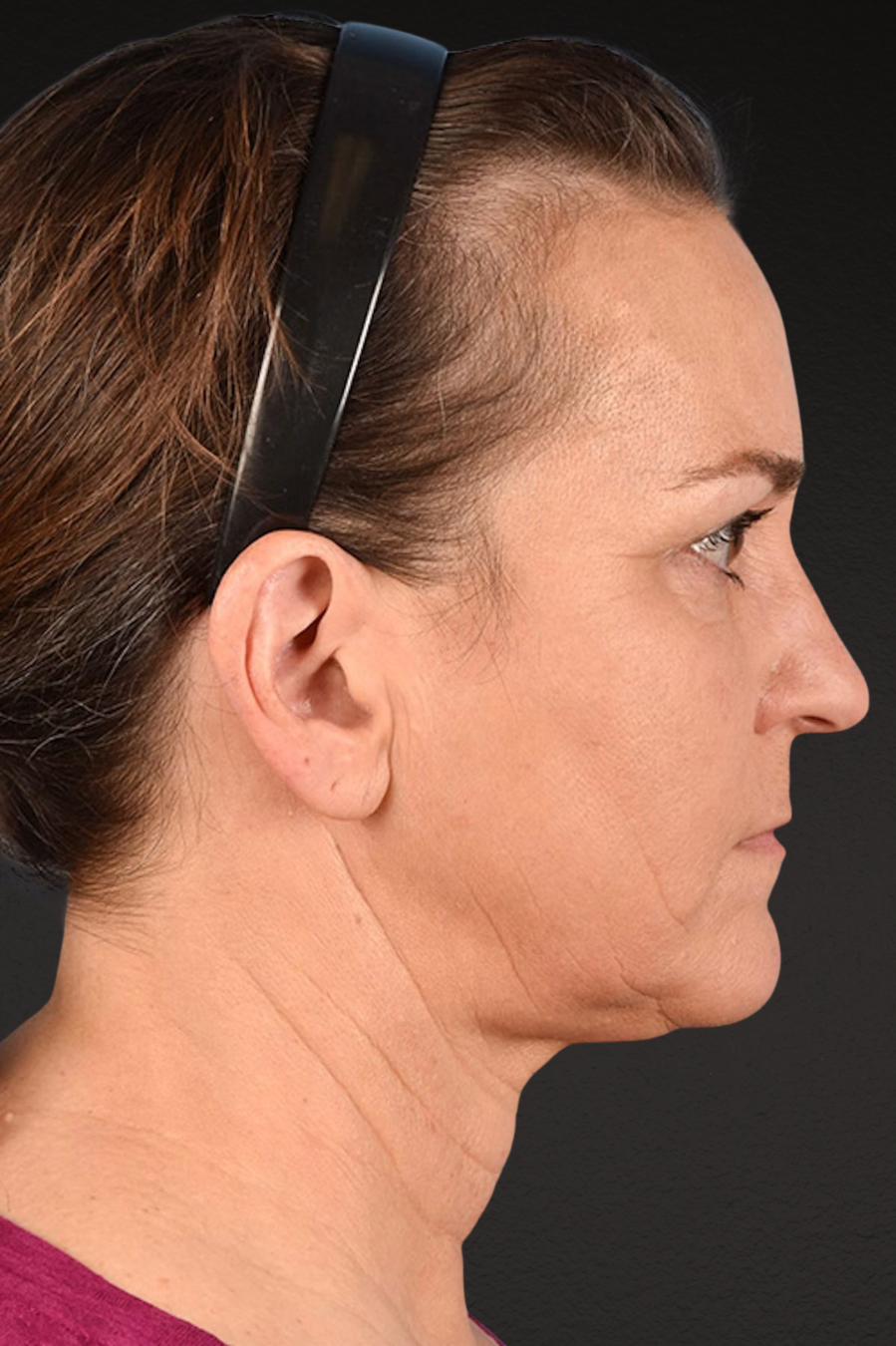 Neck Lift Before & After Gallery - Patient 169561 - Image 6