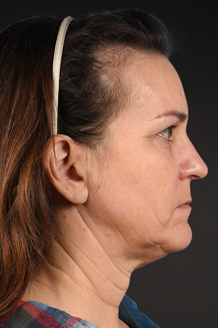 Neck Lift Before & After Gallery - Patient 169561 - Image 5
