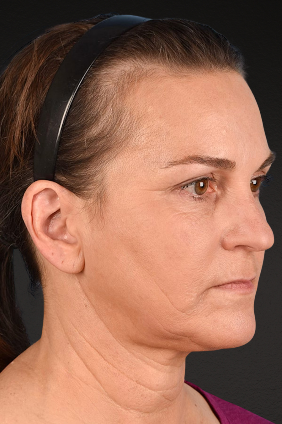 Neck Lift Before & After Gallery - Patient 169561 - Image 4