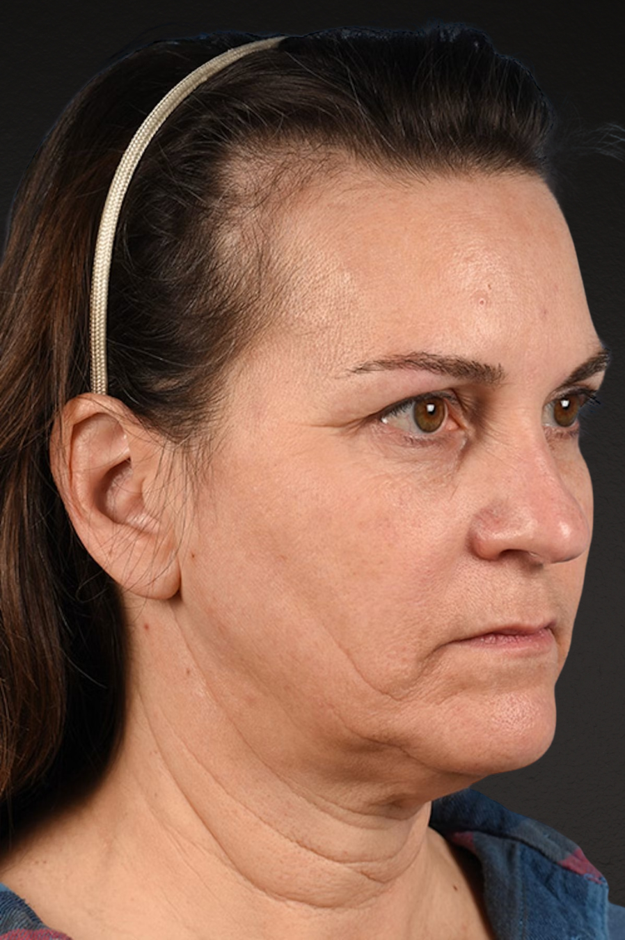Neck Lift Before & After Gallery - Patient 169561 - Image 3