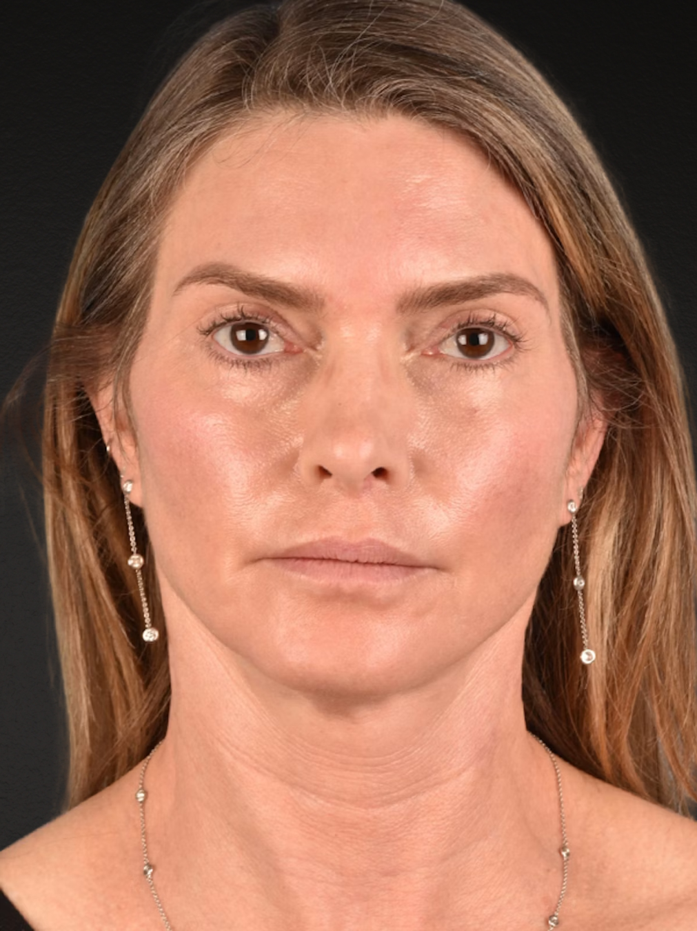 Neck Lift Before & After Gallery - Patient 223130 - Image 2