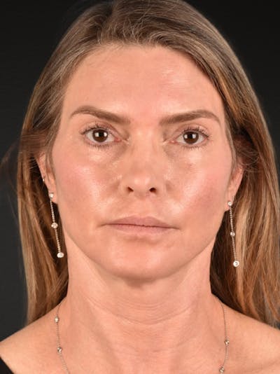 Neck Lift Before & After Gallery - Patient 223130 - Image 2
