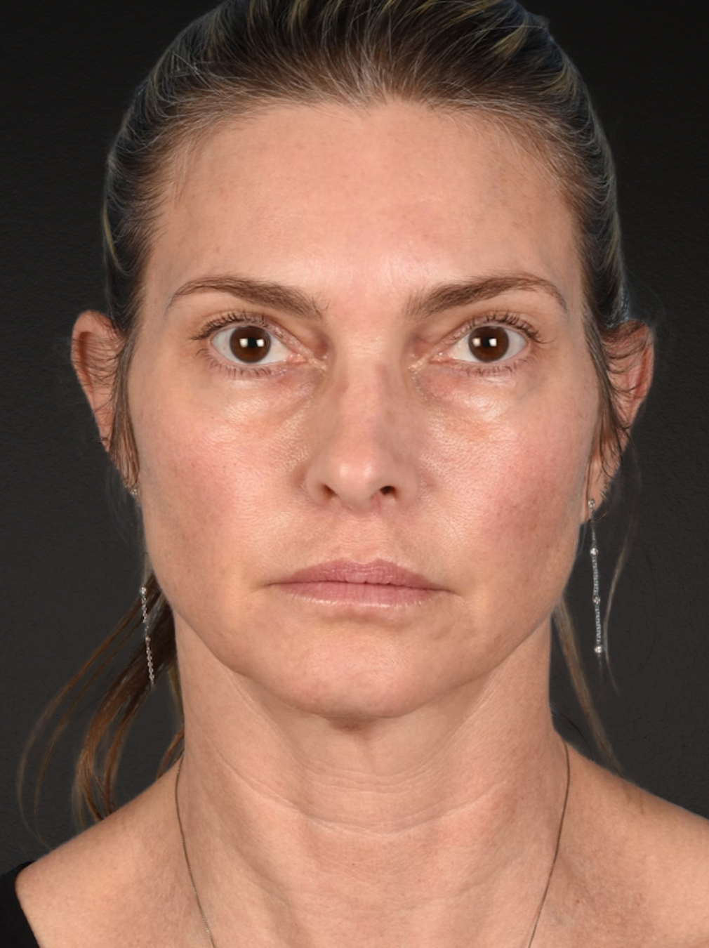 Neck Lift Before & After Gallery - Patient 223130 - Image 1