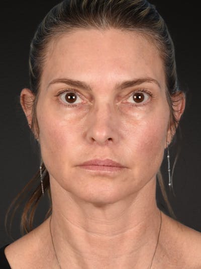 Neck Lift Before & After Gallery - Patient 223130 - Image 1