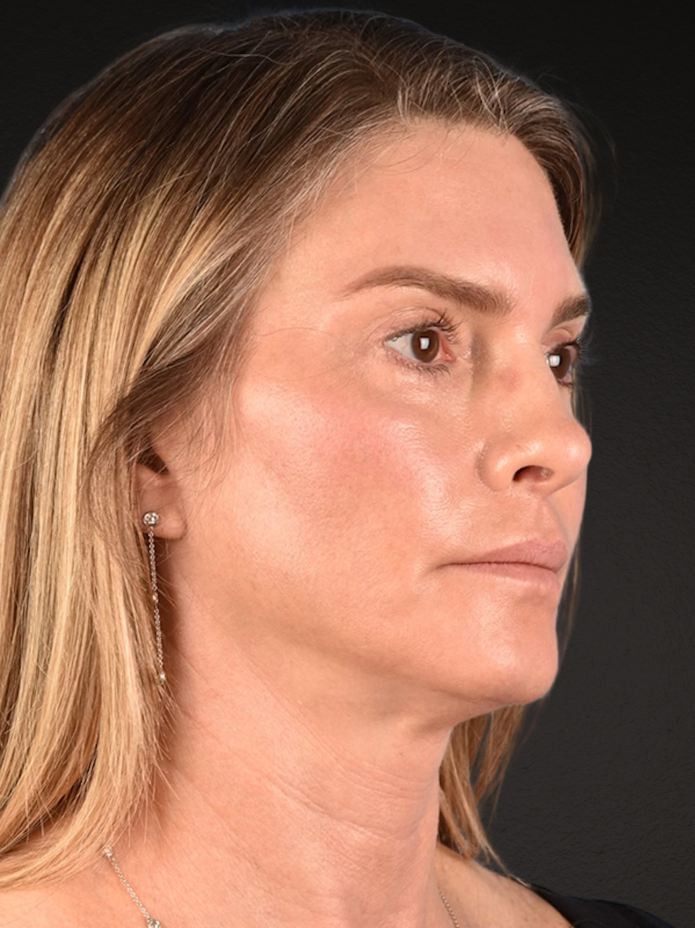 Neck Lift Before & After Gallery - Patient 223130 - Image 4