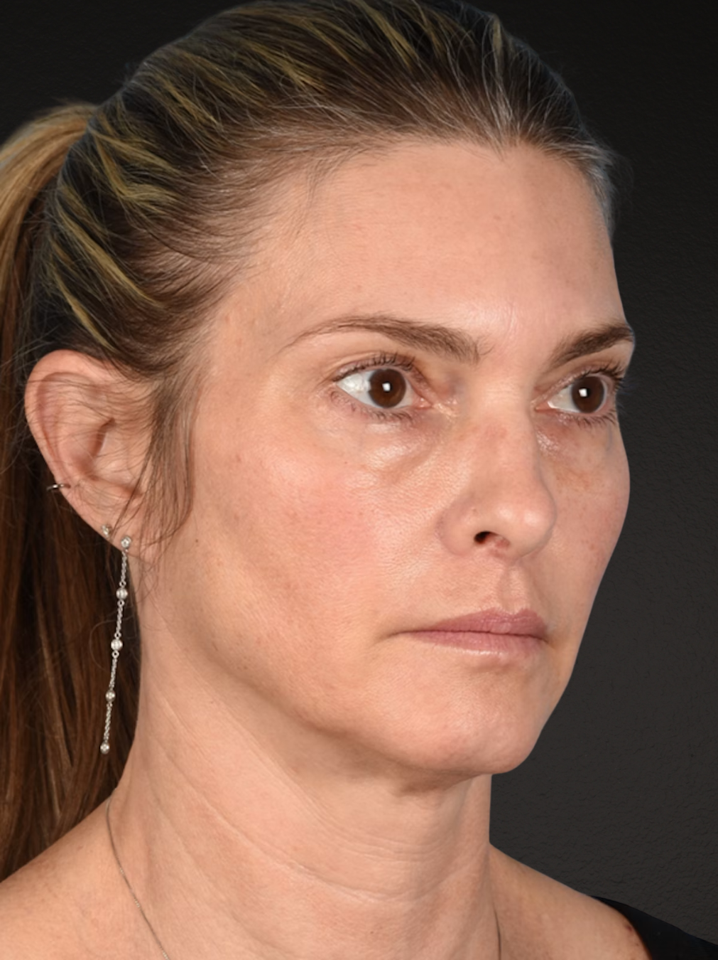 Neck Lift Before & After Gallery - Patient 223130 - Image 3