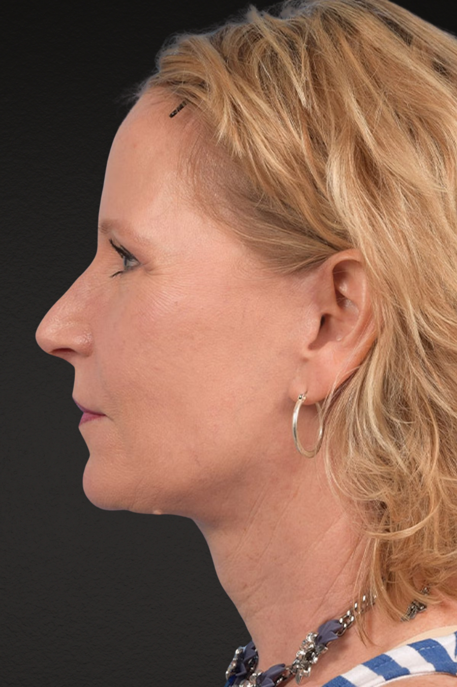 Neck Lift Before & After Gallery - Patient 250758 - Image 6