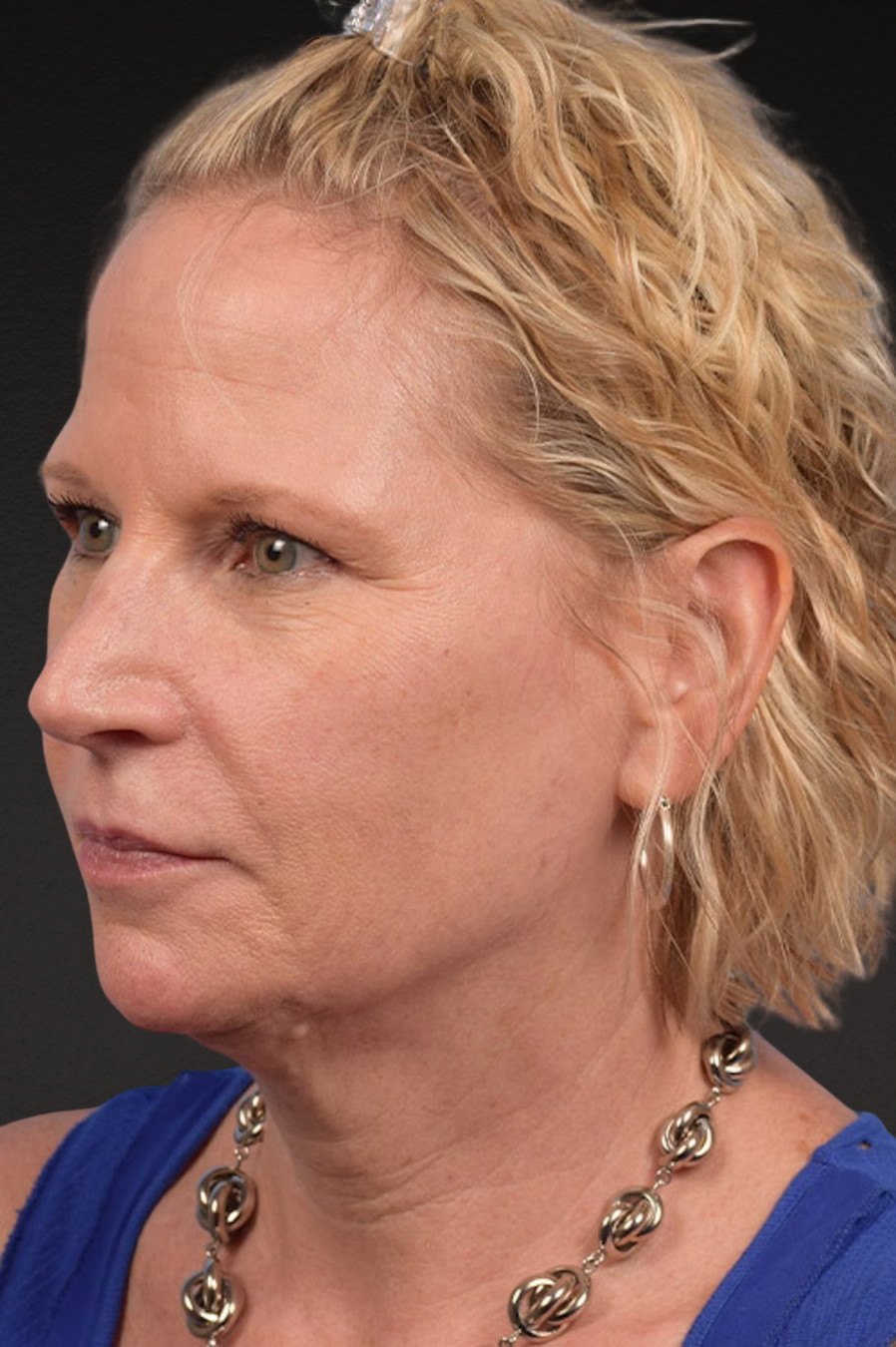 Neck Lift Before & After Gallery - Patient 250758 - Image 3