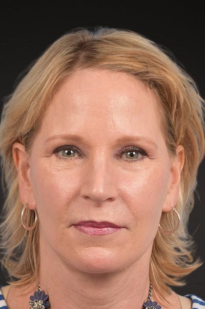 Neck Lift Before & After Gallery - Patient 250758 - Image 2