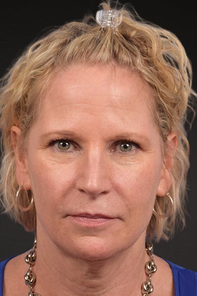 Neck Lift Before & After Gallery - Patient 250758 - Image 1