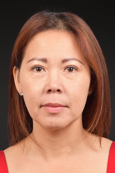 Neck Lift Before & After Gallery - Patient 289705 - Image 2