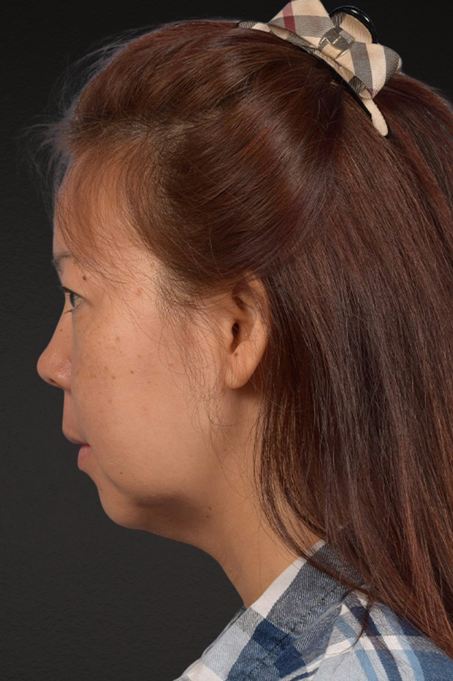 Neck Lift Before & After Gallery - Patient 289705 - Image 9