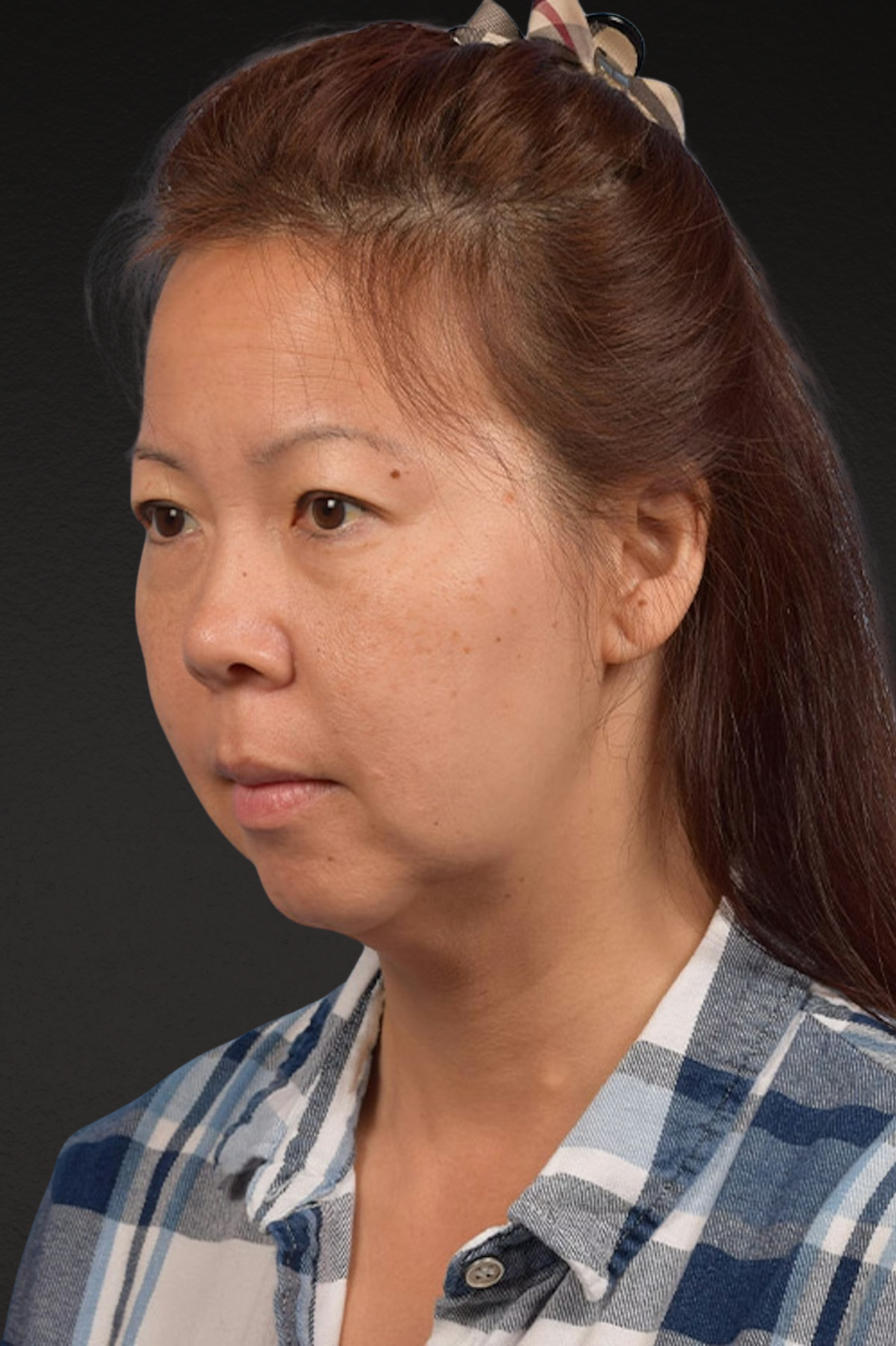 Neck Lift Before & After Gallery - Patient 289705 - Image 7