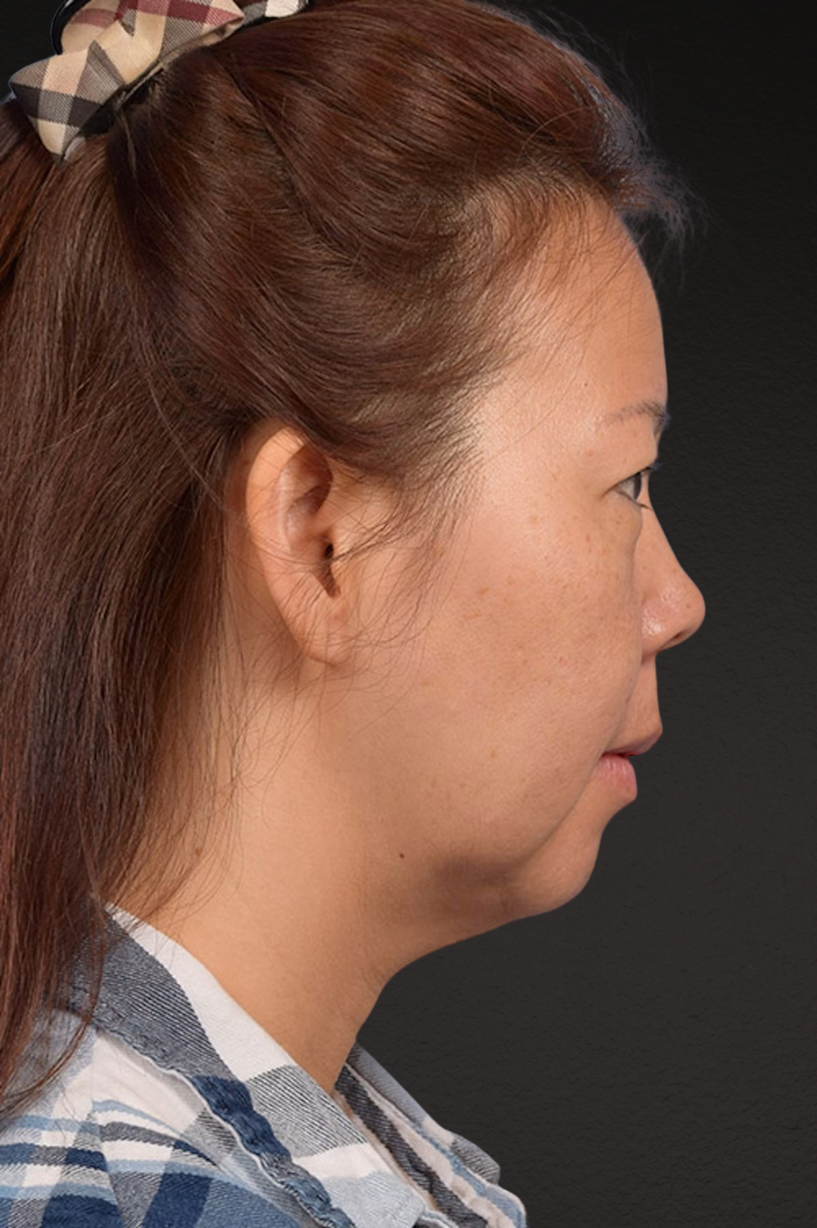 Neck Lift Before & After Gallery - Patient 289705 - Image 5
