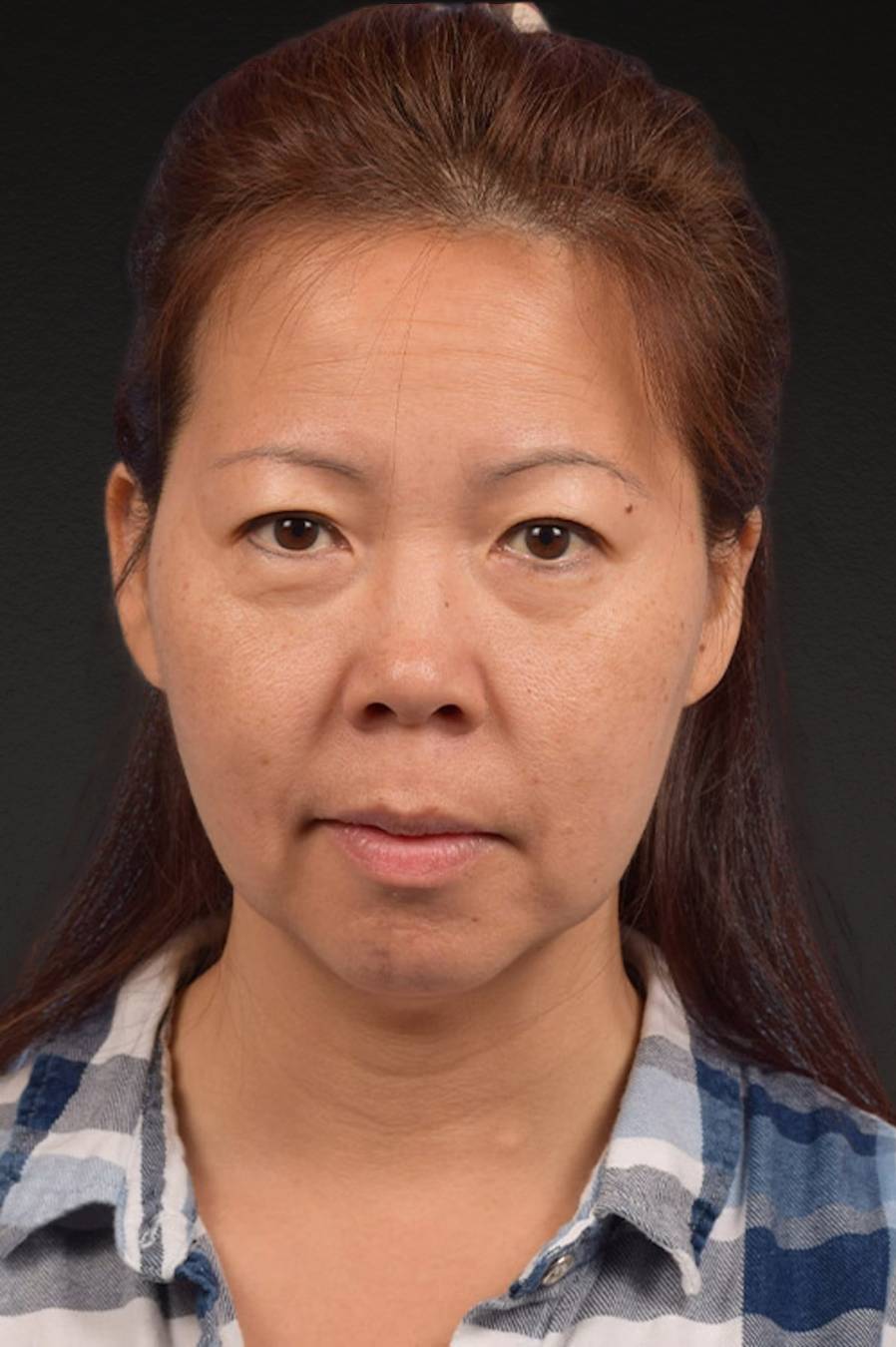 Neck Lift Before & After Gallery - Patient 289705 - Image 1