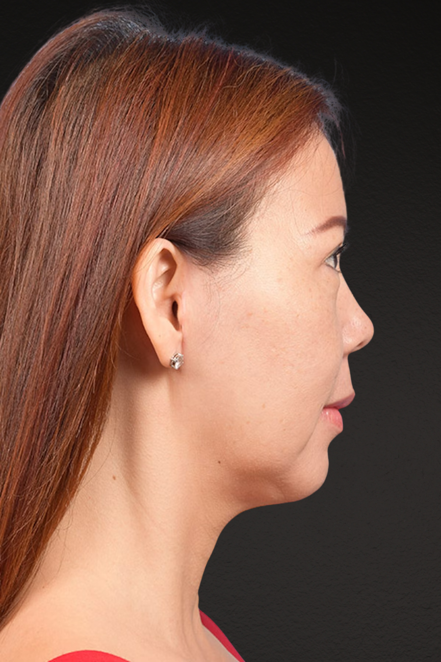 Neck Lift Before & After Gallery - Patient 289705 - Image 6