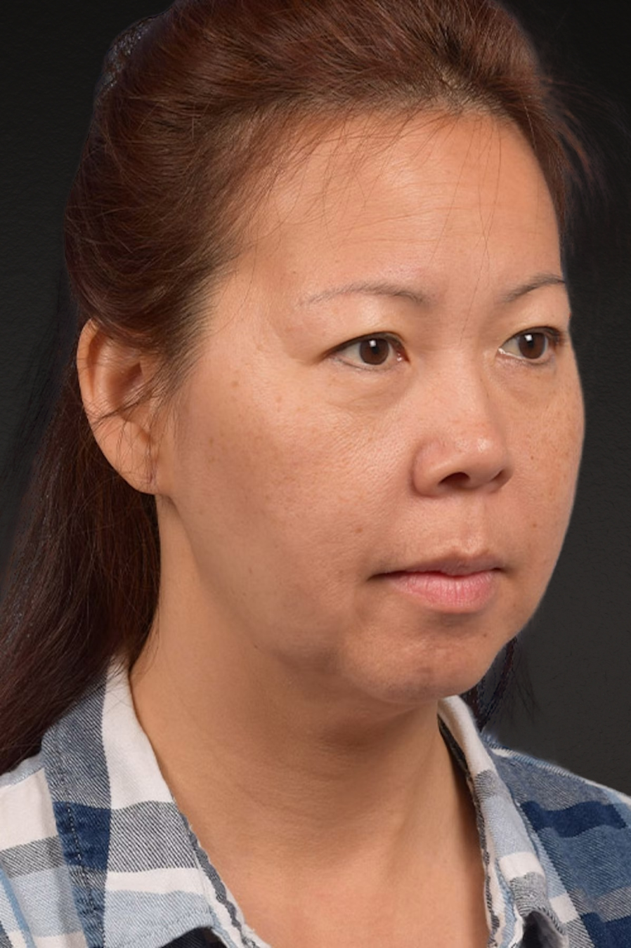 Neck Lift Before & After Gallery - Patient 289705 - Image 3