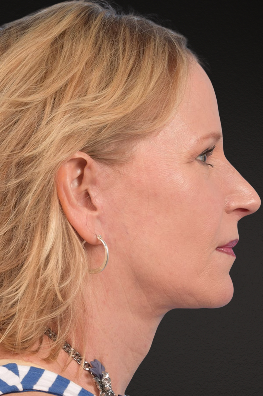 Neck Lift Before & After Gallery - Patient 250758 - Image 10
